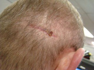 Acell Scar Repair Patient December 19 2008 Acell Scar Repair Patient December 19 2008