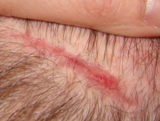 Acell Scar Repair Patient Friday December 19 2008 Acell Scar Repair Patient Friday December 19 2008