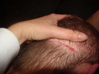 Acell Scar Repair Patient January 7 2009 Acell Scar Repair Patient January 7 2009