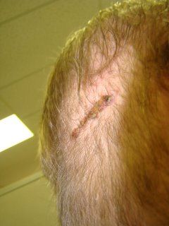 Acell Scar Repair Patient November 24 2008 Acell Scar Repair Patient November 24 2008