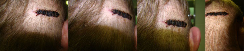 Acell Scar Repair Patient One Week Post OP Acell Scar Repair Patient One Week Post OP