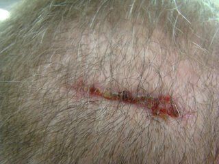 Acell Scar Repair Patient Six Weeks Acell Scar Repair Patient Six Weeks