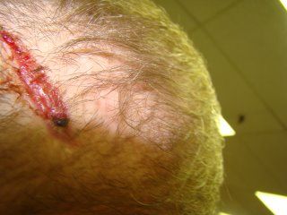 Acell Scar Repair Patient Two Week Post OP Acell Scar Repair Patient Two Week Post OP