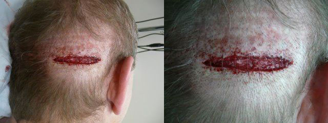 Acell Scar Repair Patient 