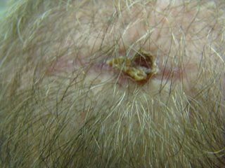Acell Scar Repair Treatment After Six Weeks Acell Scar Repair Treatment After Six Weeks