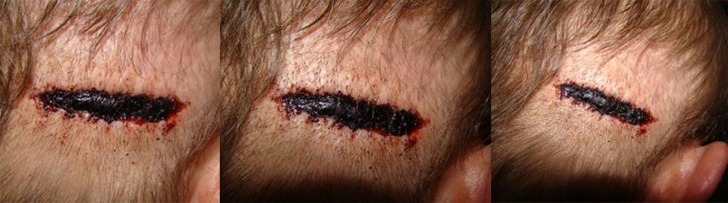 Acell Scar Repair Treatment Acell Scar Repair Treatment