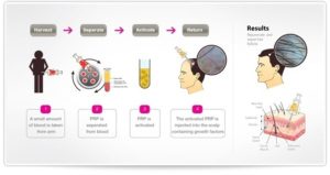 Platelet-Rich Plasma PRP THTS