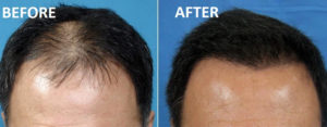 PRP for Hair Loss THTS