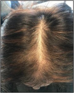 Female Pattern Baldness THTS
