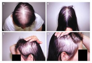 Female Pattern Hair Loss THTS