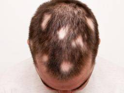 Man With Alopecia Areata Stress Hair Loss