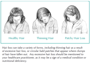 Type of Hair loss in women Type of Hair loss in women