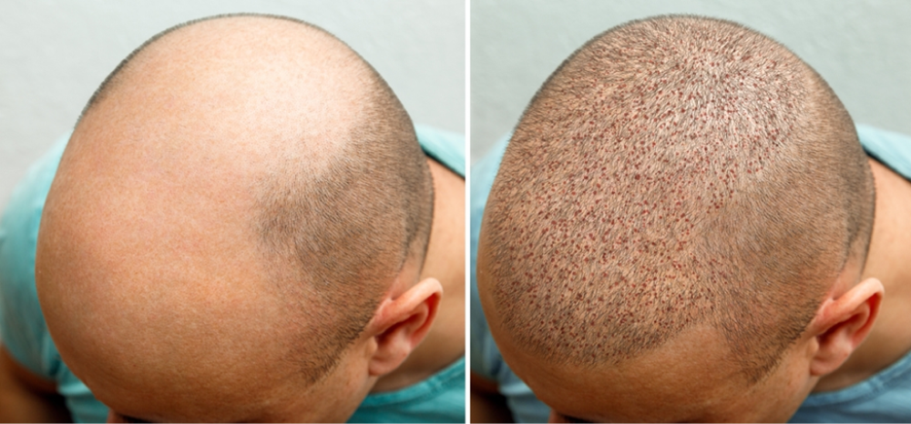 Hair Transplant Surgery Correction Previous Procedures