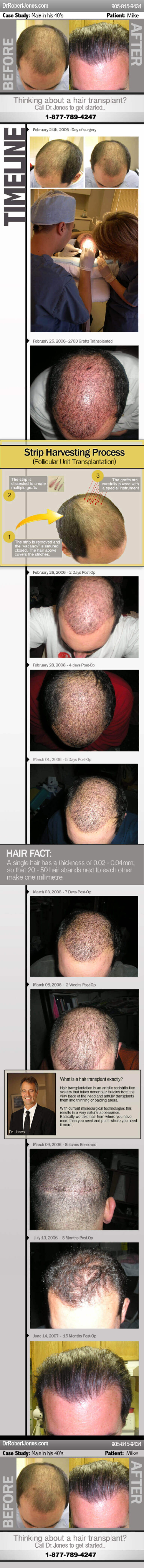 Hair Transplant Case Study Mike Infographic