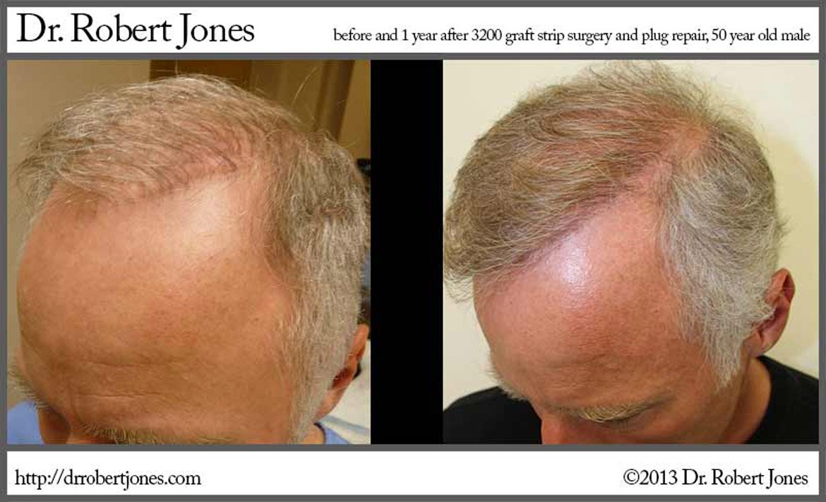 3200 Graft Hair Transplant 50 Yr Male