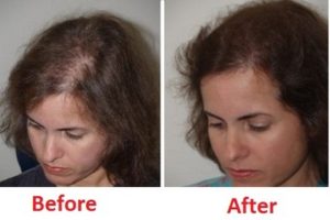 Laser Cap for Hair loss