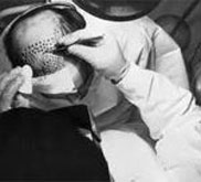 Hair Transplants Treating Hair Loss