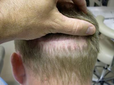 Botox Scar Reduction Before Treatment Donor Scar