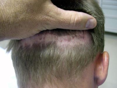 Botox Scar Reduction 6 Months Botox Side Results