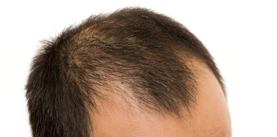 genetics-and-hair-loss-img