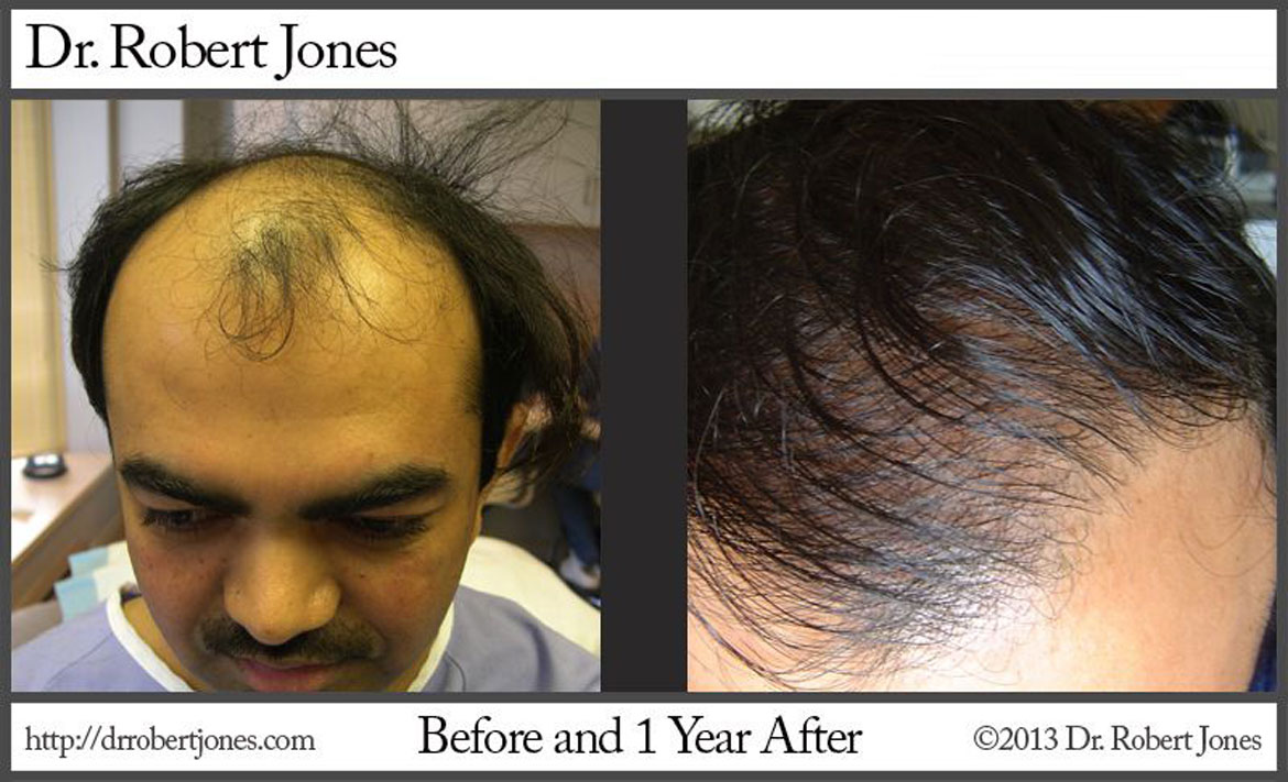 Combine Hair Loss Treatment Strategies