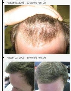technique-of-hair-transplants-img1