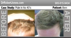 technique-of-hair-transplants