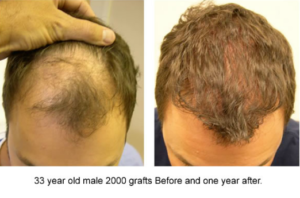 How Do Hair Transplant Work