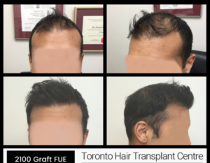 Toronto Hair Transplant Surgeons - 2100 Graft FUE Case Study