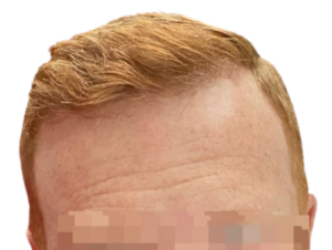 3000 Graft FUE - 1 yr post-op