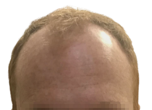 Before 3000 Graft FUE