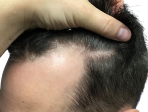 BEFORE - 40 yr M 2000 graft FUE