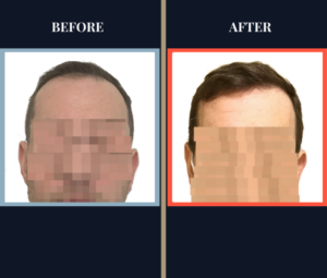 2400 GRAFT FUE HAIR TRANSPLANT