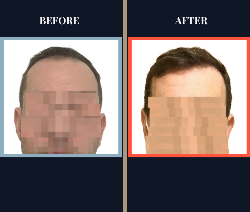 2400 GRAFT FUE HAIR TRANSPLANT