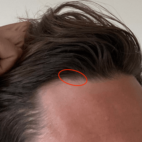 No-Shave FUE - 50 Grafts - 3 years Post-Op