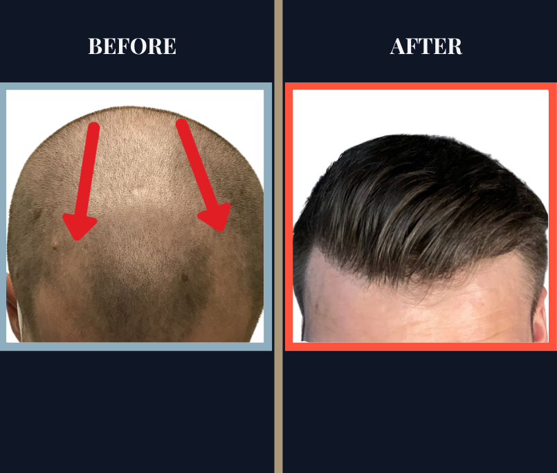 1500 G FUE HAIR TRANSPLANT RESULT