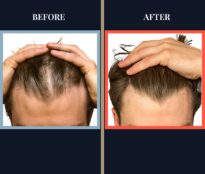 1520 graft FUE HAIR TRANSPLANT