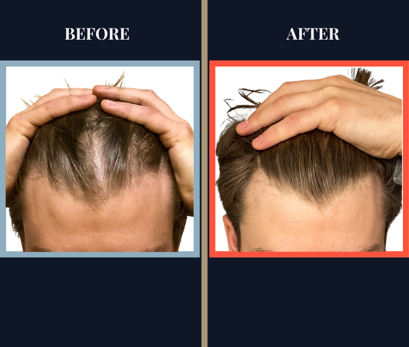 1520 graft FUE HAIR TRANSPLANT
