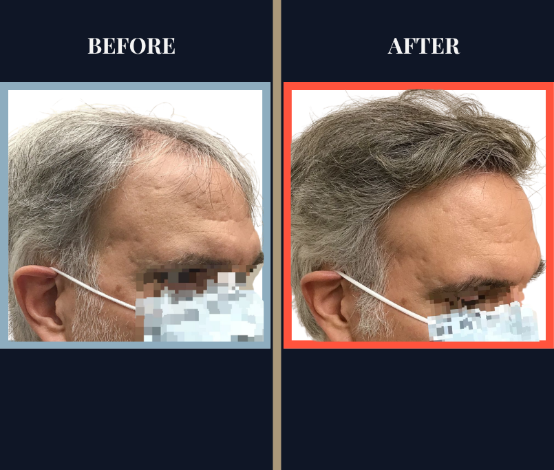 2091 GRAFT HAIR TRANSPLANT