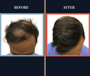 2250 G FUT Hair Transplant