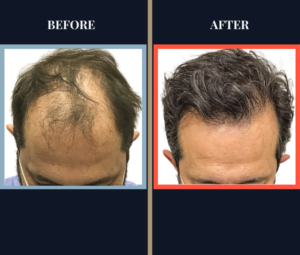 2800 G FUE Hair Transplant