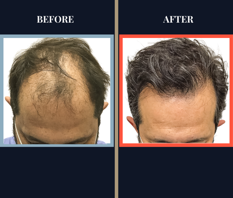 2800 G FUE Hair Transplant