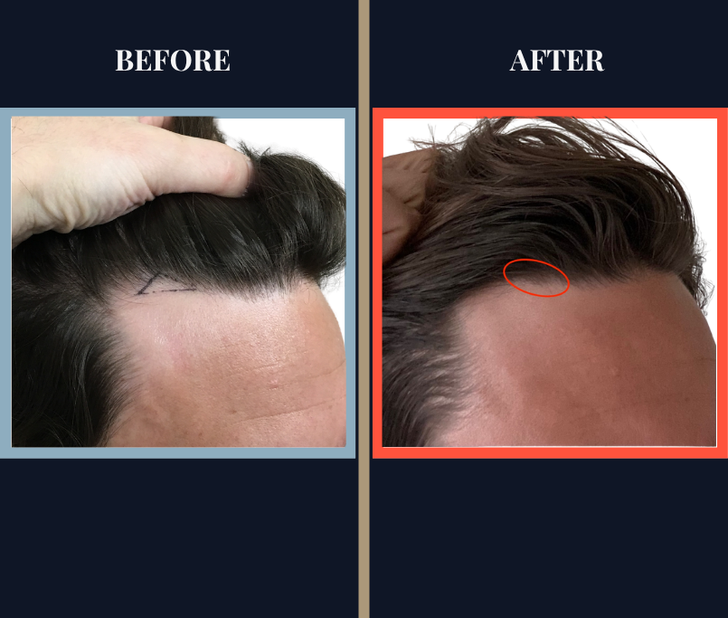 No Shave - 50 GRAFT FUE HAIR TRANSPLANT