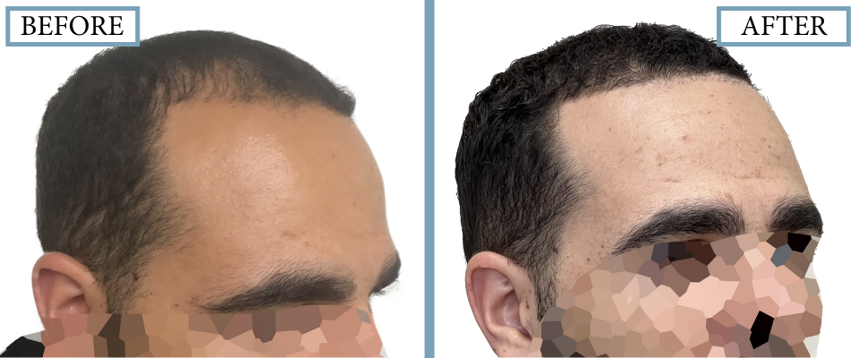 THTS Before and After FUE