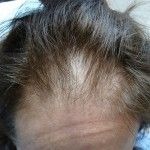 Before Hair Transplant