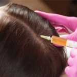 PRP Treatment for Hair Loss