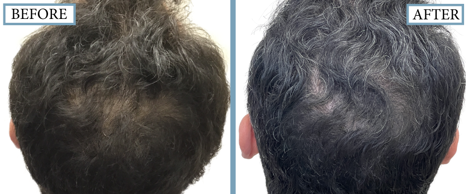 THTS Before and After FUE