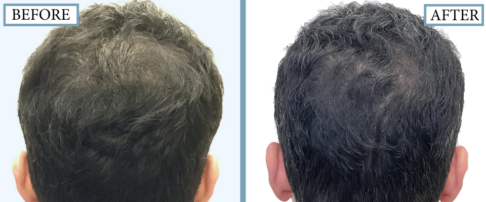 THTS Before and After FUE