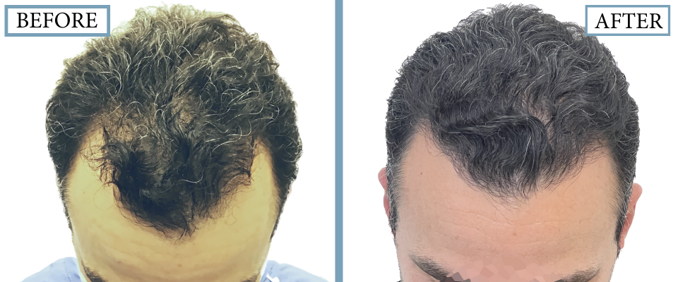 THTS Before and After FUE