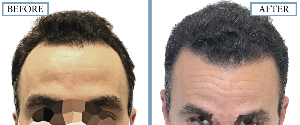 THTS Before and After FUE